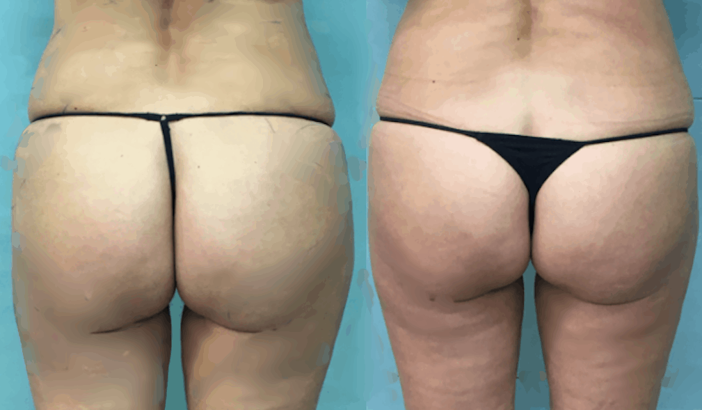 aqualix en cartuchera y glúteos