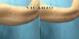 Disminucion de la flacidez en extremidades superiores