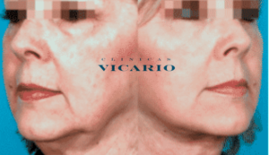 Hilos Tensores antes y despues facial