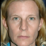 Hilos Tensores Clinicas Vicario