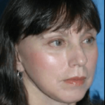 Hilos Tensores Clinicas Vicario