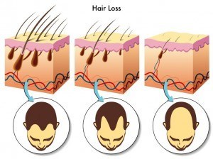 alopecia2