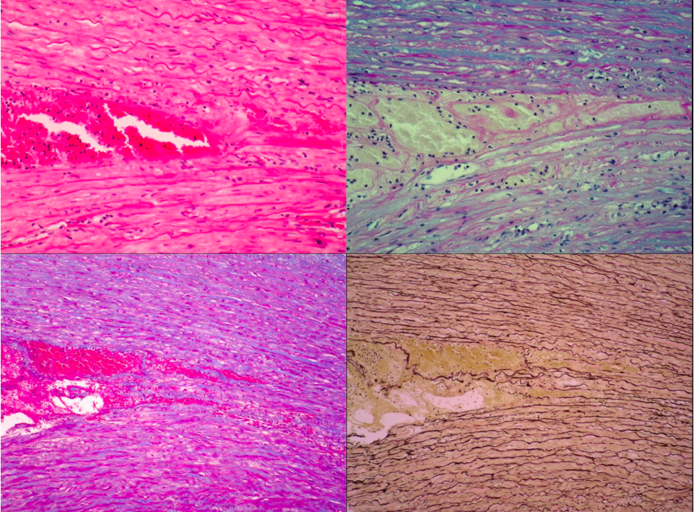 Microscopia electrónica - cambios en las fibras de colágeno con la edad