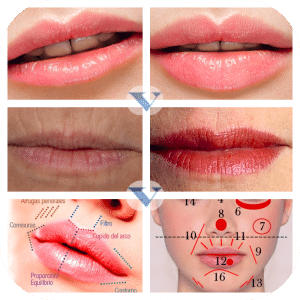 acido hialuronico antes y despues labios