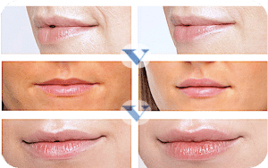 acido hialuronico labios