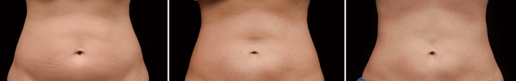 criolipolisis clinicas vicario