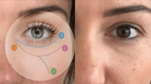 Redenty eyes antes y después