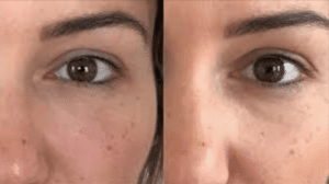 antes y después ÁCIDO HIALURÓNICO OJERASEyes