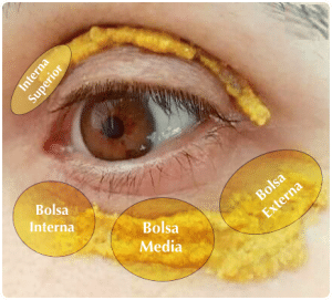 Blefaroplastia sin cirugia bolsas ojos