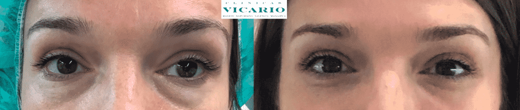 Mejor Tratamiento Bolsas Ojos