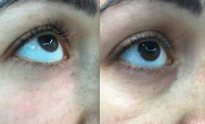 antes y desoyes redensity