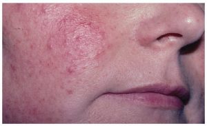 Las "venitas" rojas del escote tienen solución