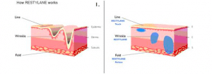restylane-histologia