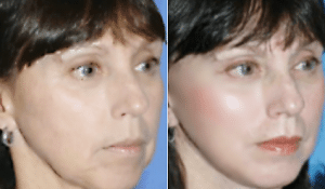 Hilos tensores Técnica de Lifting 3D patentada por Clínicas Vicario . hilos tensores antes y despuÉs
