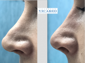 Rinomodelacion la rinoplastia sin cirugia