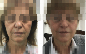 Antes y despues Hilos Tensores Técnica de Lifting 3D patentada por Clínicas Vicario FACIAL