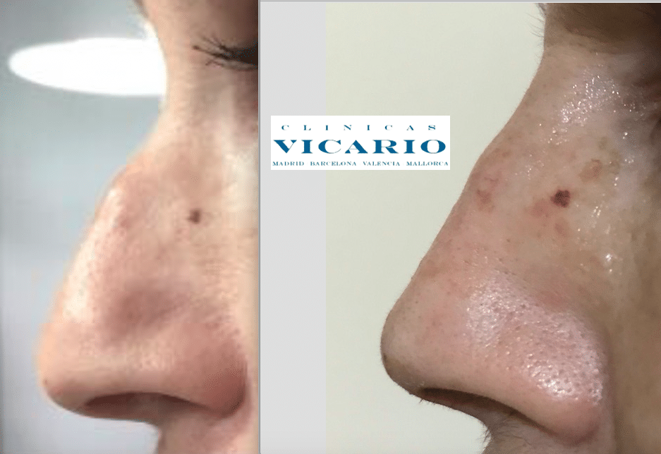 rinomddelación con elevación de la punta nasal