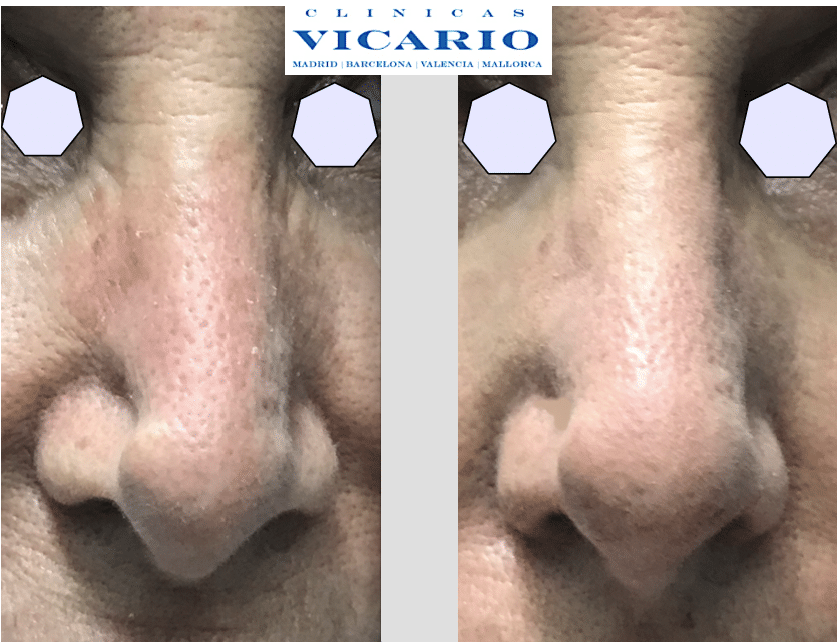 Rinomodelacion la rinoplastia sin cirugia general
