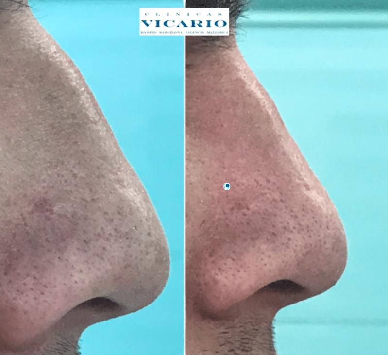 RinomodelaciON ELEVAR PUNTA