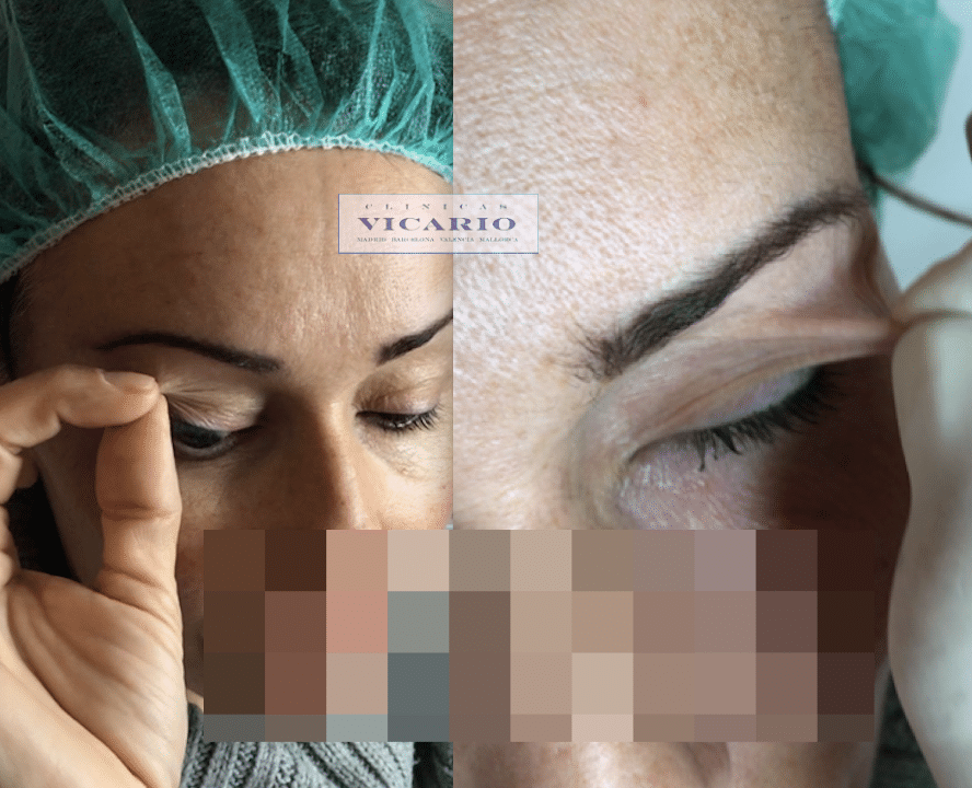 blefaroplastia sin cirugia antes superior