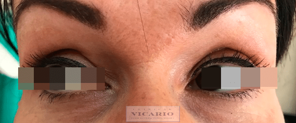 blefaroplastia después de 1 mes