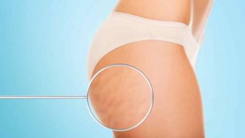 Las 6 frutas que debes comer para tratar la celulitis