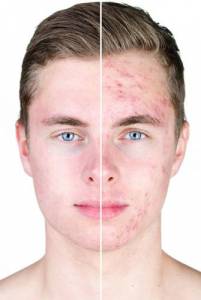 Eliminar rojeces y cicatrices