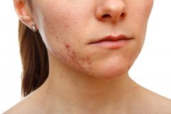 peeling clinica vicario
