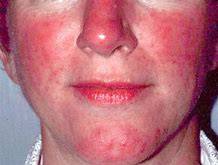 enrojecimiento facial clinica vicario