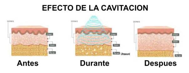 cavitación Clinica Vicario