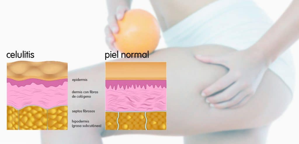 celulitis clinica vicario