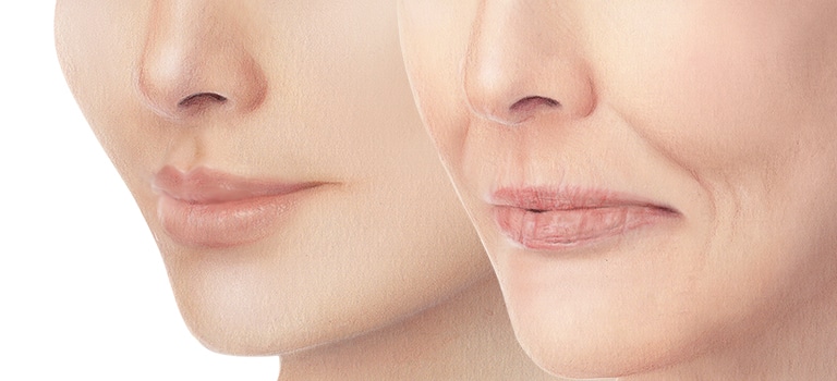 suco nasogeniano Clinica Vicairo Madrid