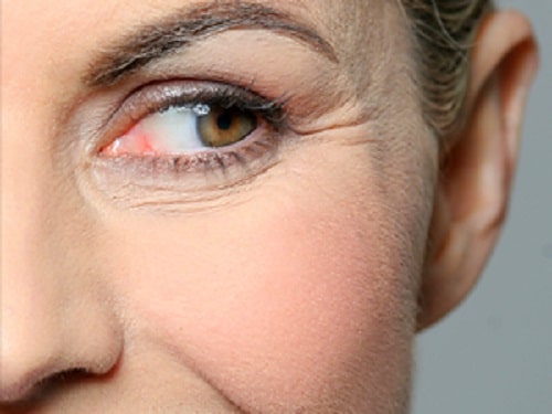 arrugas y líneas de expresión Clinica Vicario