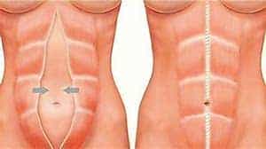 barriga hinchada blog Clinica Vicario