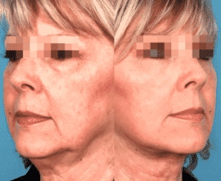 antes y despues tratamientos con hilos Técnica de Lifting 3D patentada por Clínicas Vicario antes2-y-despues-hilos-tensores-filtro