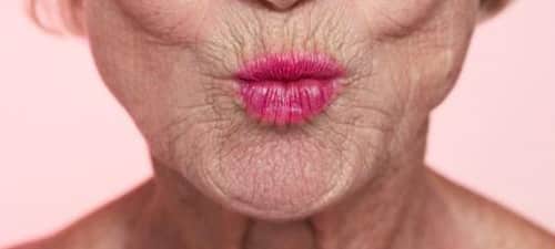 aumento de labios con acido hialuronico arrugas nasogenianas, cómo tratarlas?