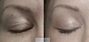 Tratamiento del exceso de piel con laser