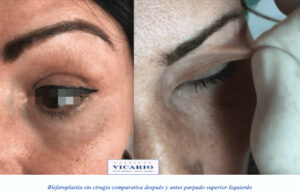 Blefaroplastia sin cirugia en parpado superior derecho