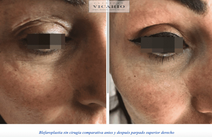Blefaroplastia sin cirugia en parpado superior izquierdo