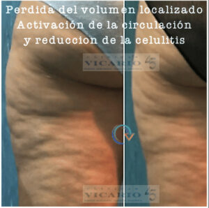 Antes y despues, tratamiento de la obesidad localizada, activación de la circulacion y disminucion de la celulitis
