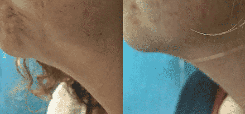 antes y después resultado de los Hilos Tensores en el cuello