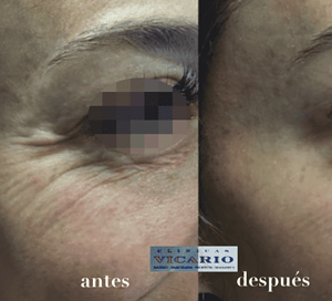 antes y despues del tratamiento en Mujer de 42 años