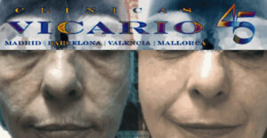 Hilos tensores faciales antes y despues 2º sesión