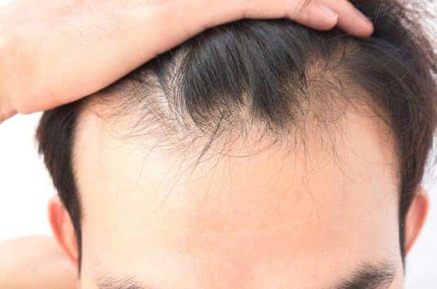 la alopecia cicatricial clinica vicario caida de pelo