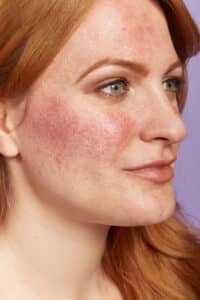rosácea