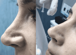 antes y despues de rinomodelacion con hilos tensores