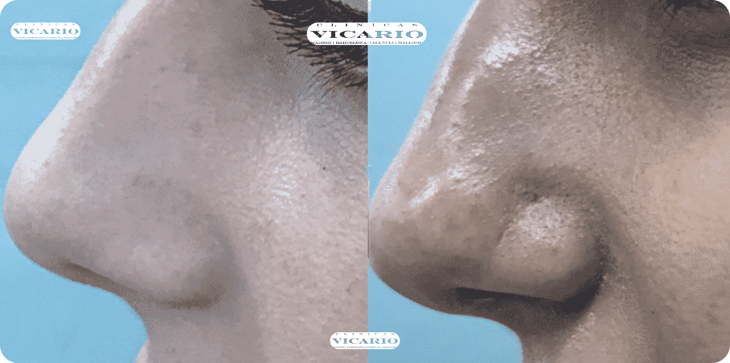 rinomodelacion estrechar nariz