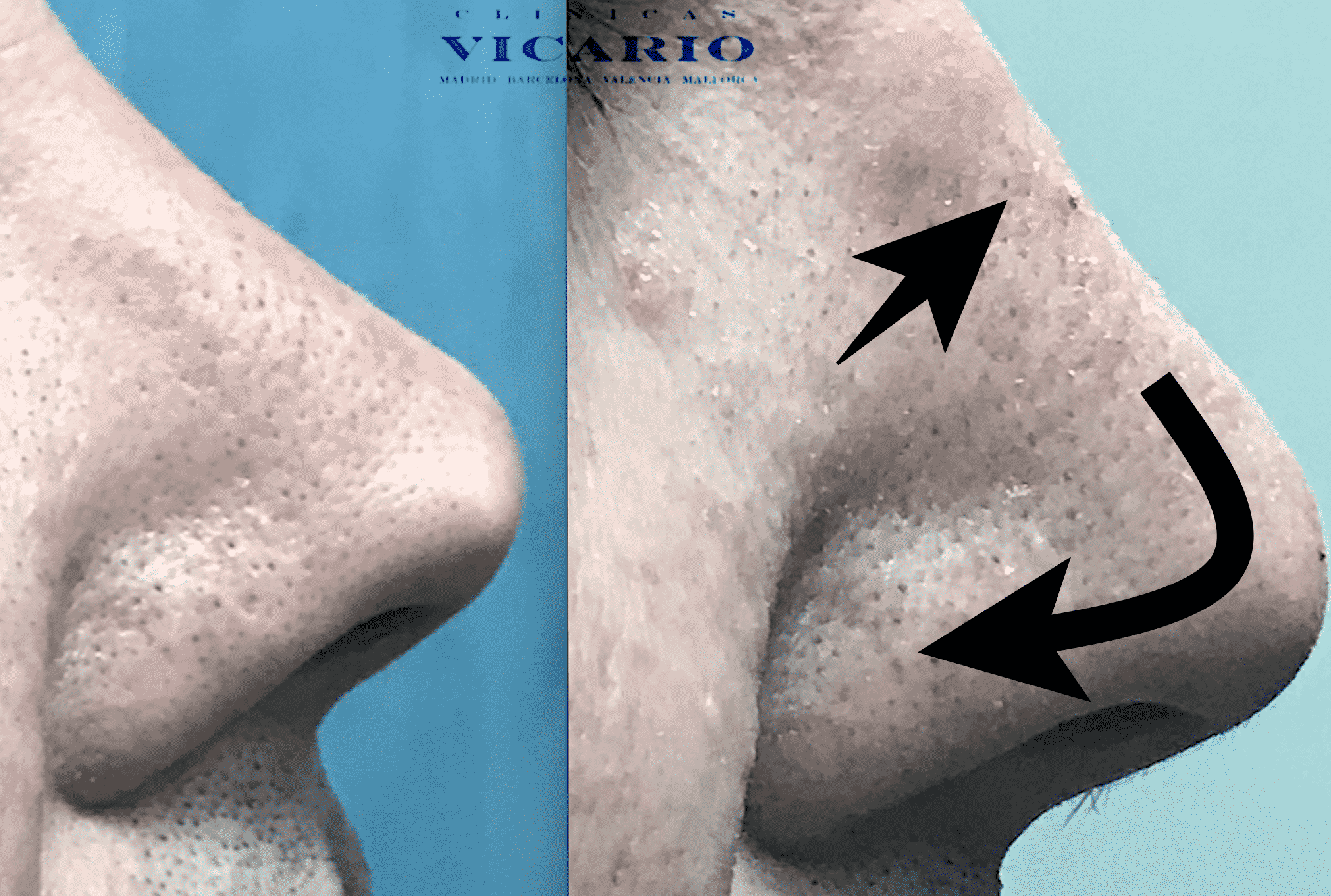 RINOMODELACION POST 2 RINOPLASTIAS