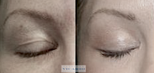 Blefaroplastia sin cirugia superior