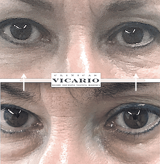 aaa-ojeras- b-antes-y-despues-de-clinica-vicario